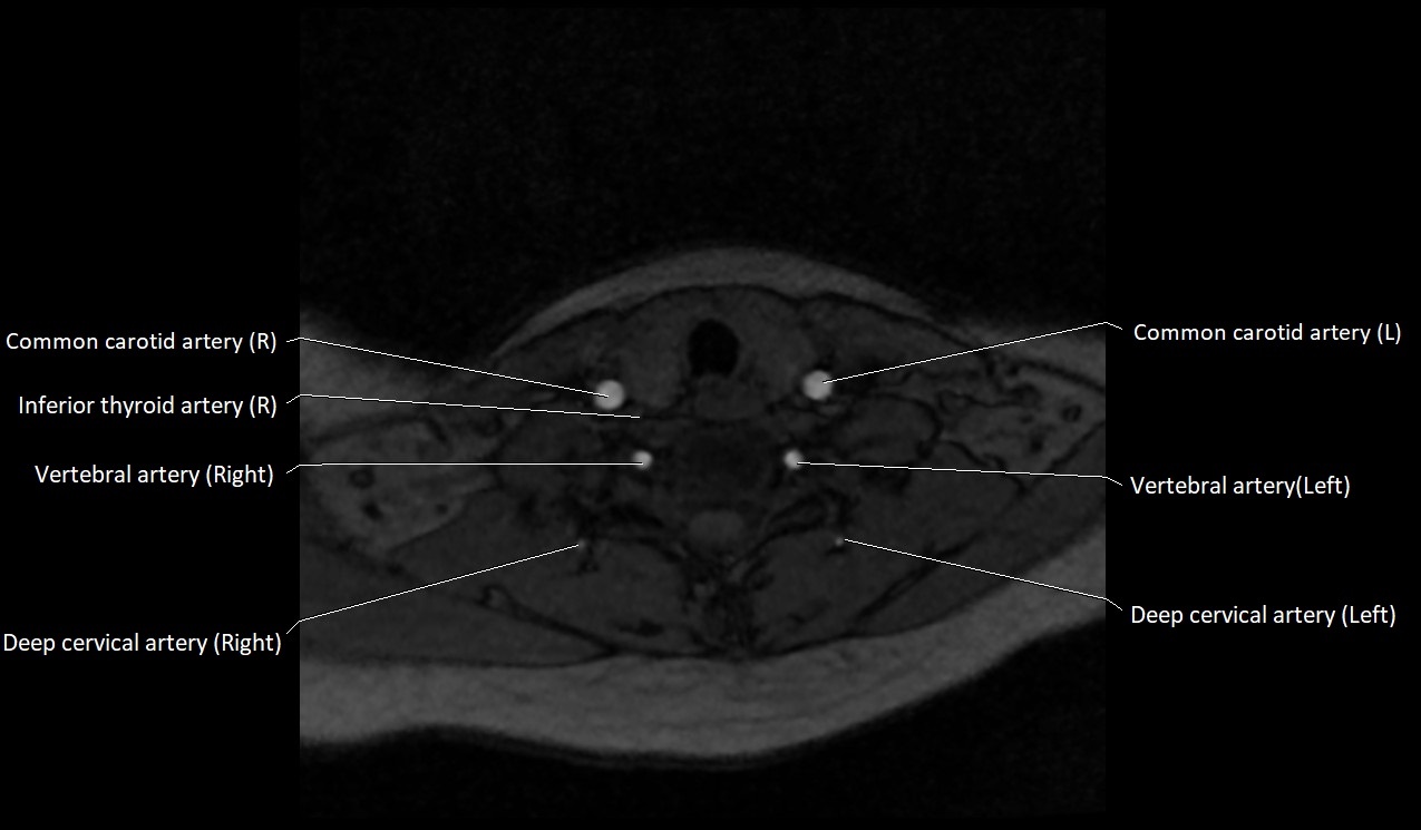 Carotid artery anatomy axial 3T image 53.jpg